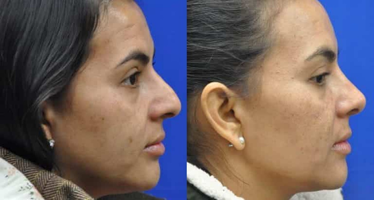 Rhinoplasty Before & After Gallery - Patient 296692 - Image 6