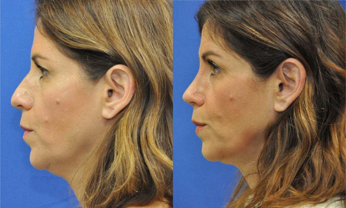 Rhinoplasty Before & After Gallery - Patient 271810 - Image 1