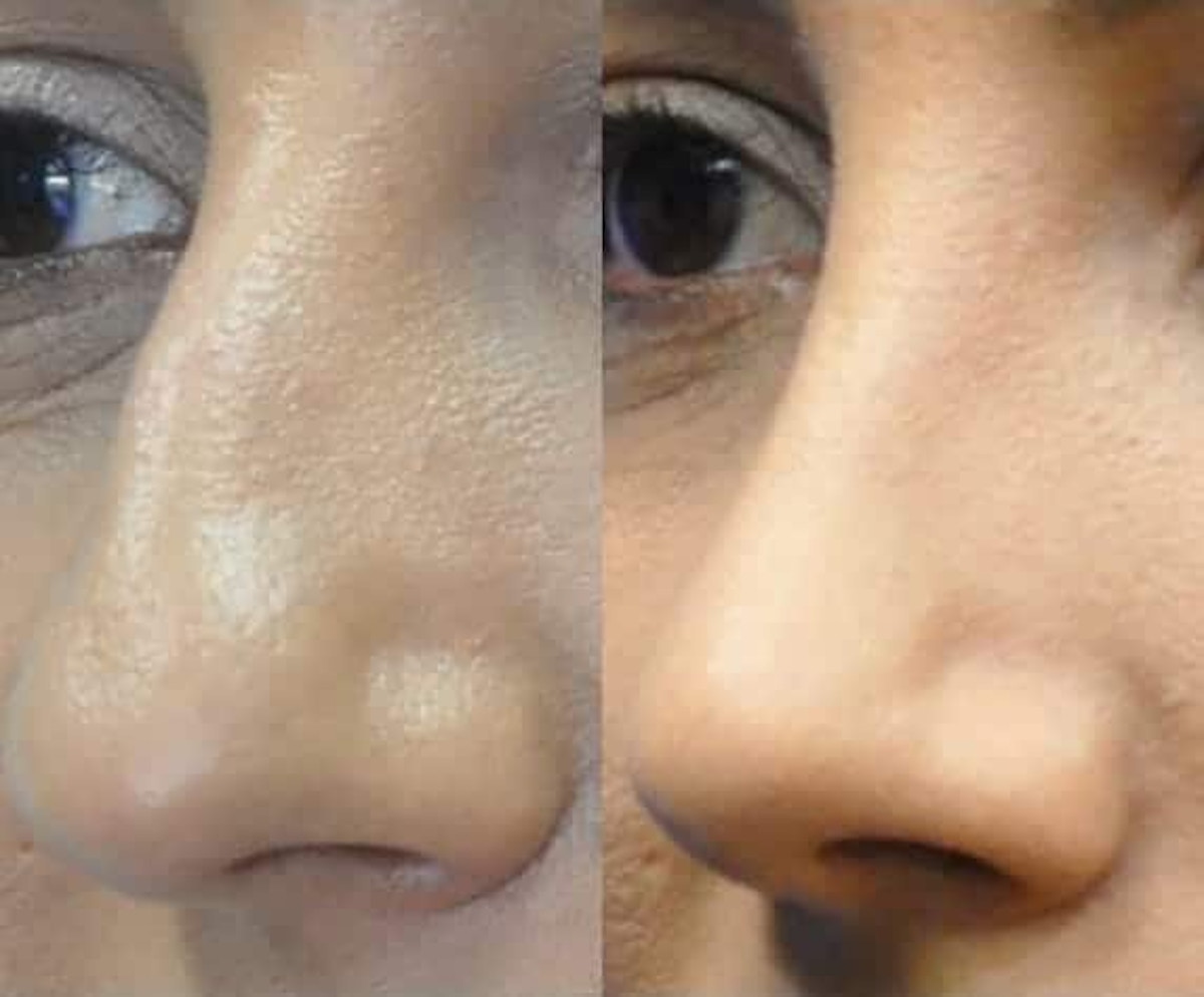 Rhinoplasty Before & After Gallery - Patient 378429 - Image 2