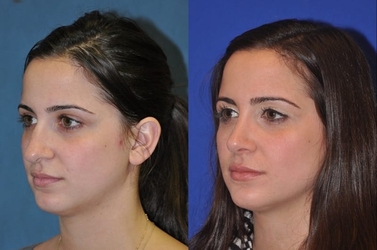 Rhinoplasty Before & After Gallery - Patient 873415 - Image 2