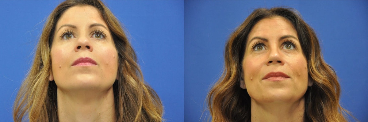Rhinoplasty Before & After Gallery - Patient 271810 - Image 5