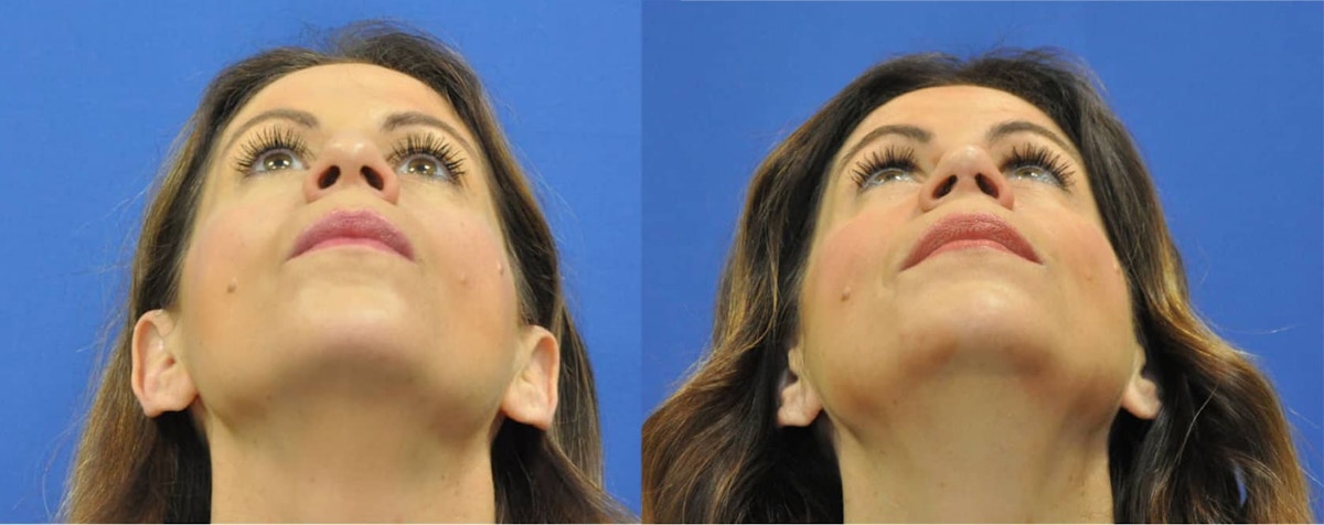 Rhinoplasty Before & After Gallery - Patient 271810 - Image 8