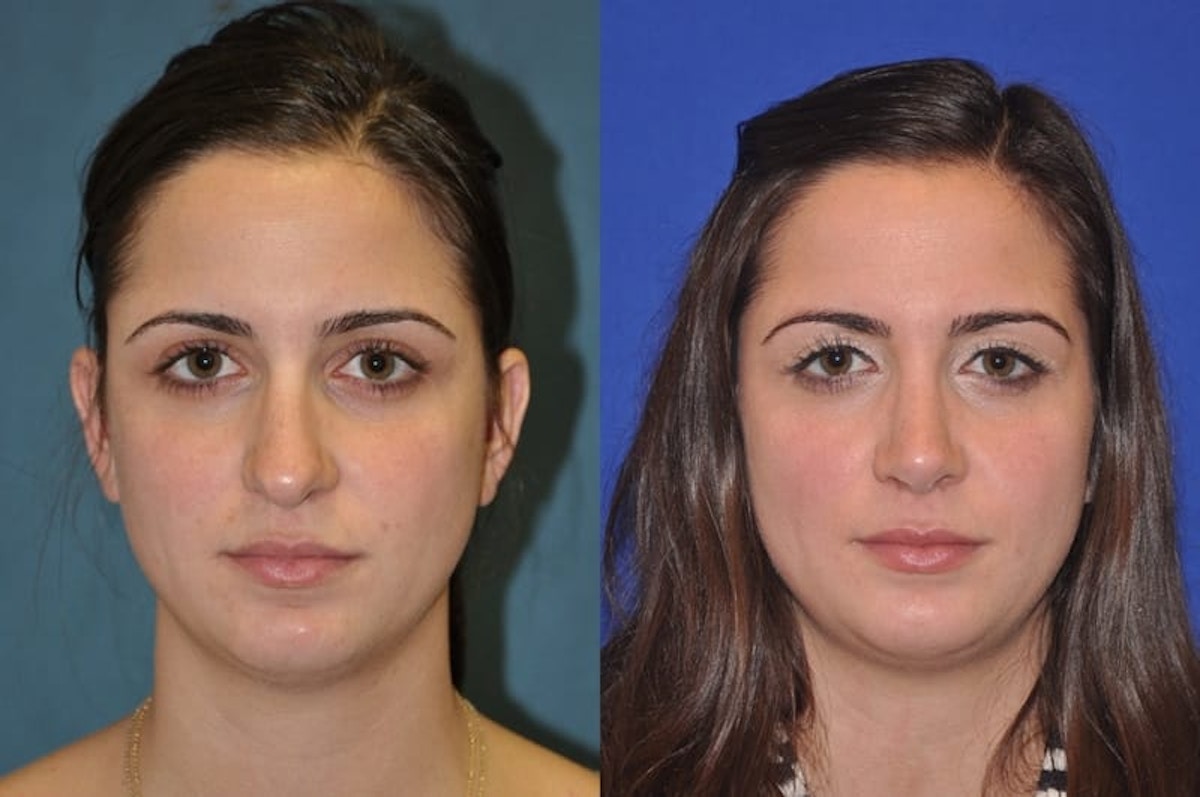 Rhinoplasty Before & After Gallery - Patient 873415 - Image 3