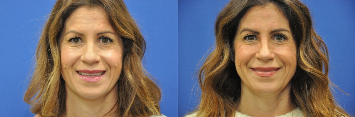 Rhinoplasty Before & After Gallery - Patient 271810 - Image 4