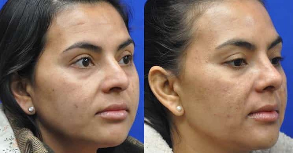 Rhinoplasty Before & After Gallery - Patient 296692 - Image 5