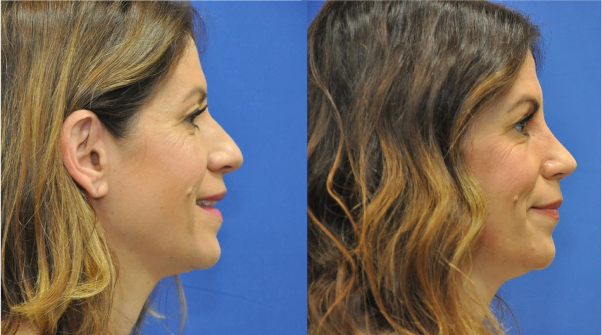 Rhinoplasty Before & After Gallery - Patient 271810 - Image 7