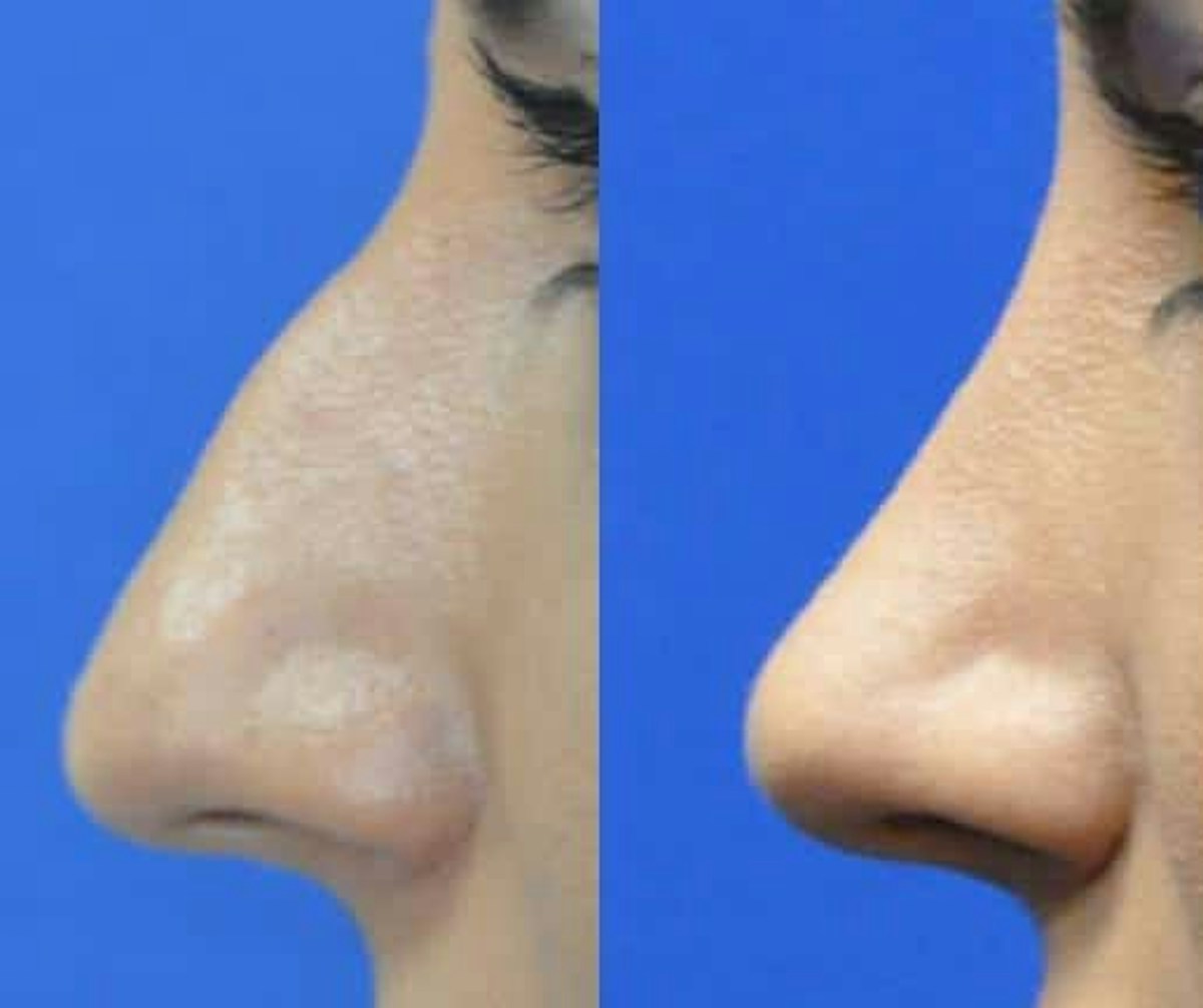Rhinoplasty Before & After Gallery - Patient 378429 - Image 1