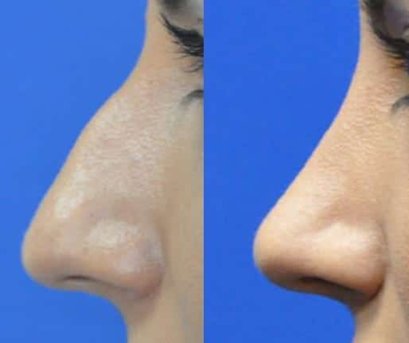 Rhinoplasty Before & After Gallery - Patient 378429 - Image 1