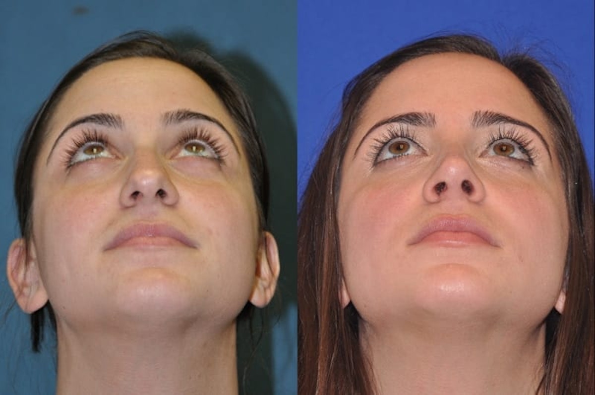 Rhinoplasty Before & After Gallery - Patient 873415 - Image 4