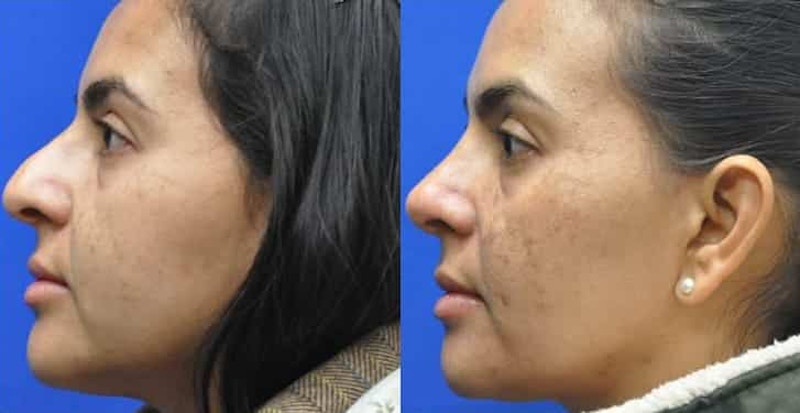 Rhinoplasty Before & After Gallery - Patient 296692 - Image 1