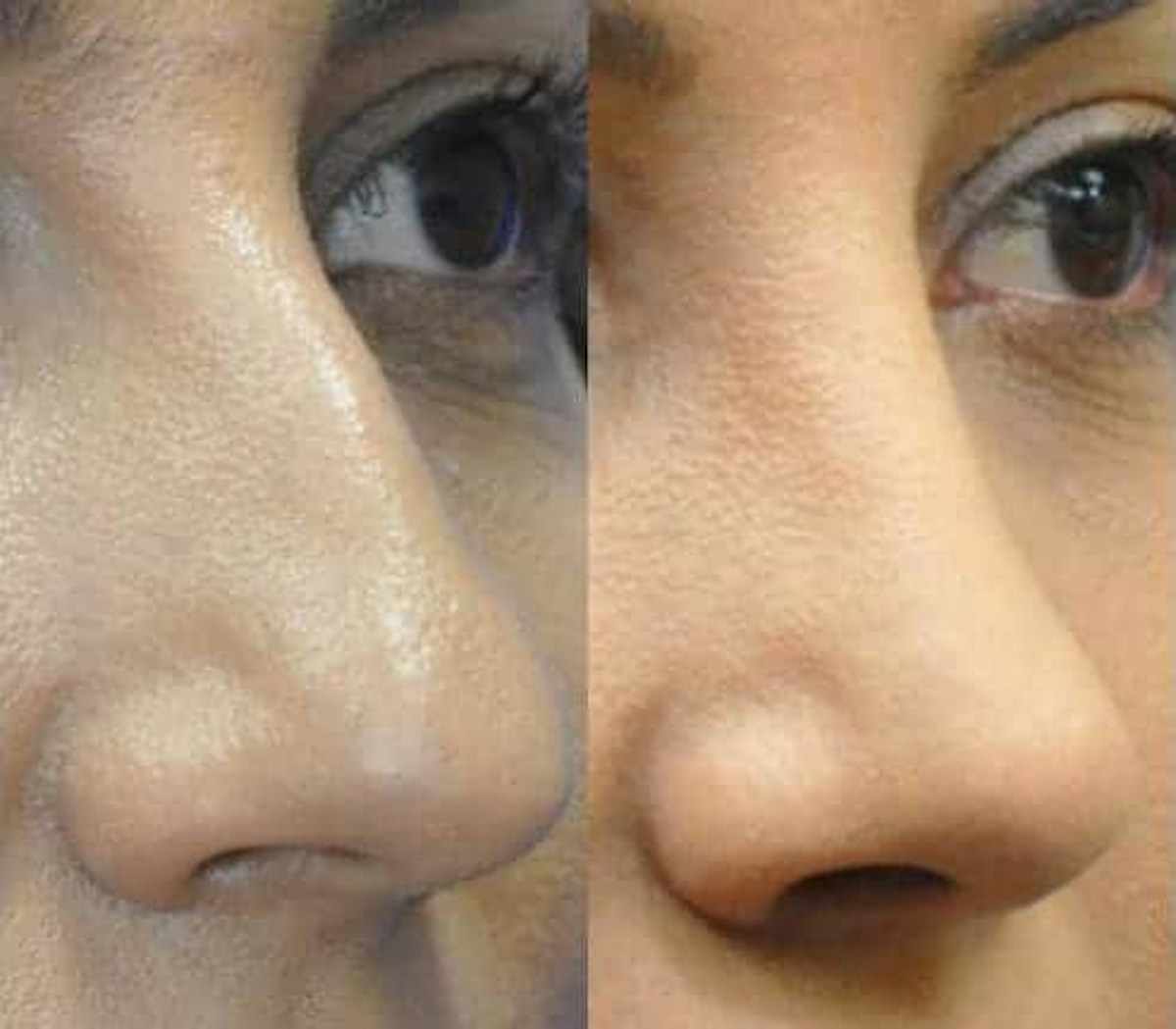 Rhinoplasty Before & After Gallery - Patient 378429 - Image 5