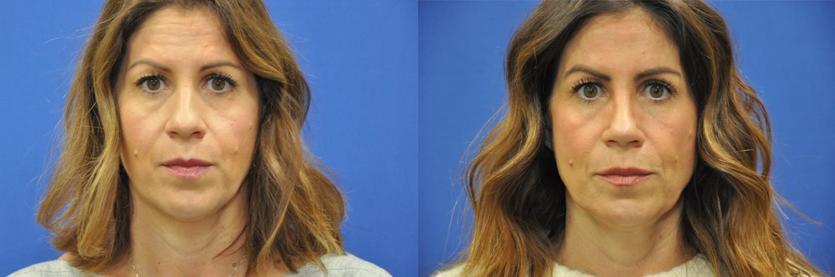 Rhinoplasty Before & After Gallery - Patient 271810 - Image 3