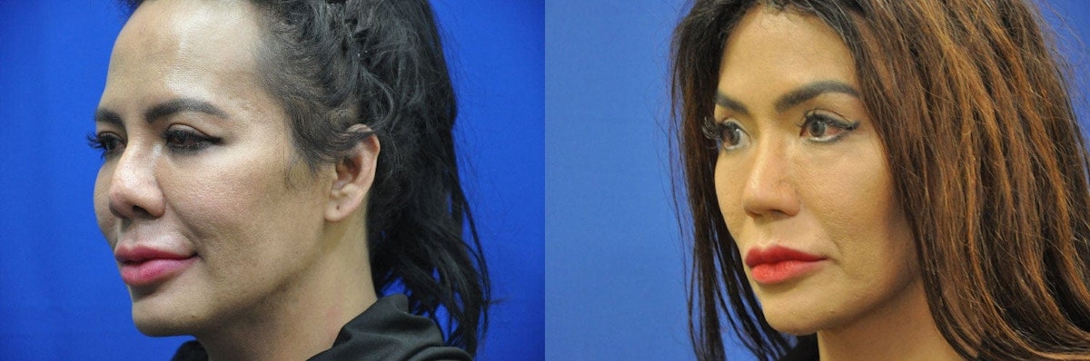 Revision Rhinoplasty Before & After Gallery - Patient 281663 - Image 2