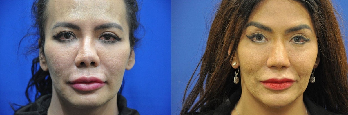 Revision Rhinoplasty Before & After Gallery - Patient 281663 - Image 1