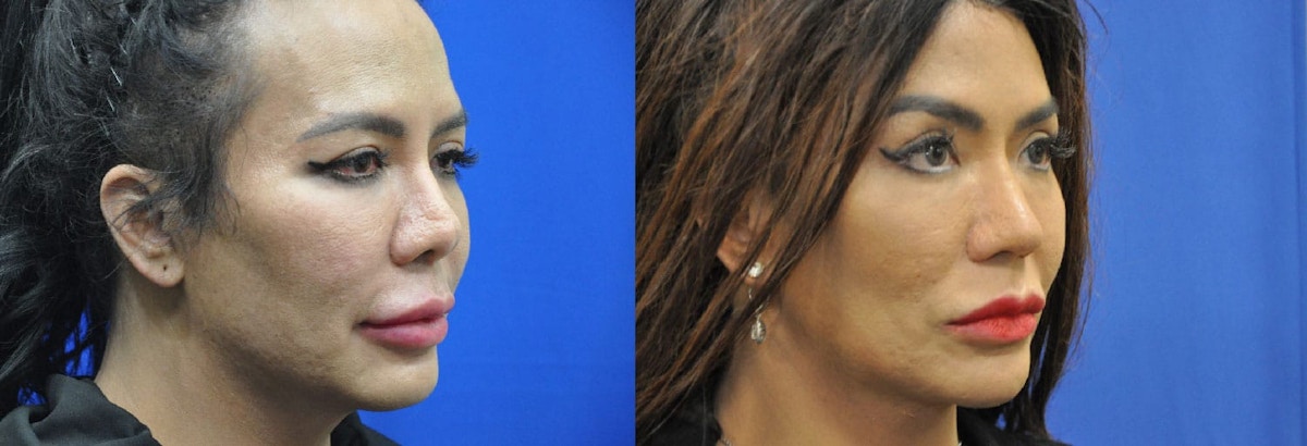 Revision Rhinoplasty Before & After Gallery - Patient 281663 - Image 5