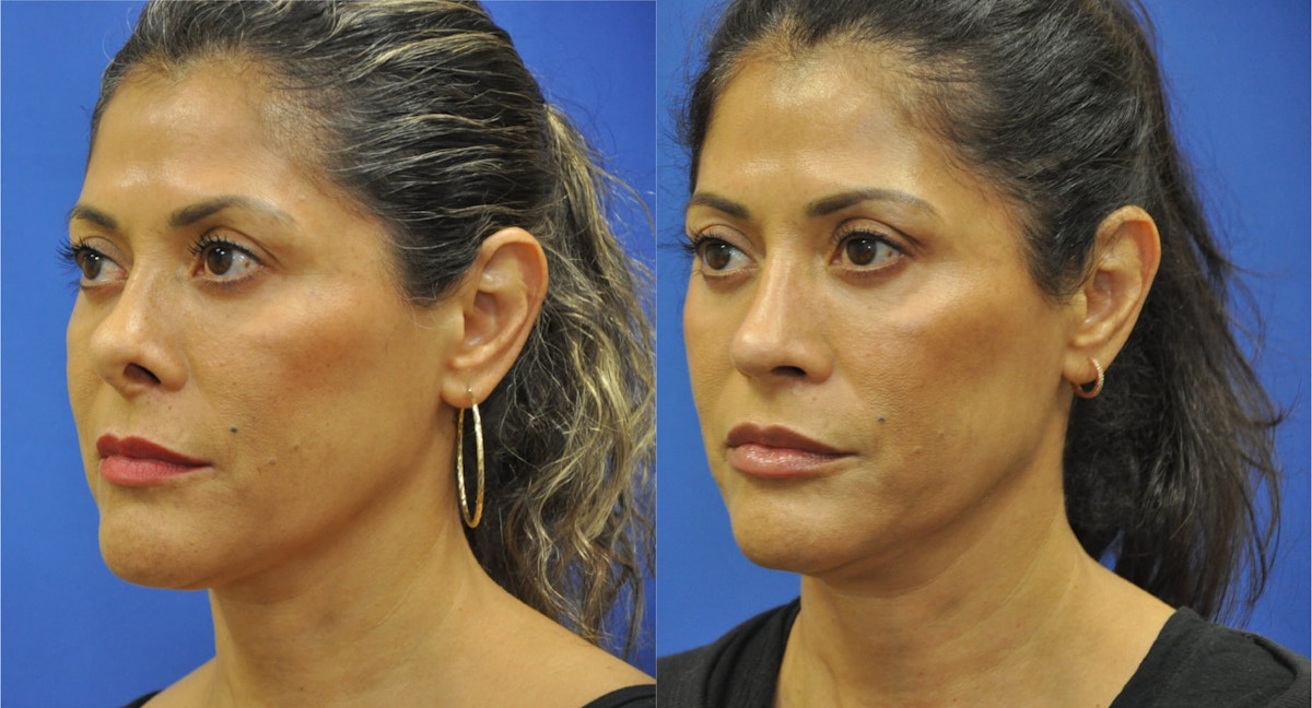 Revision Rhinoplasty Before & After Gallery - Patient 427298 - Image 3