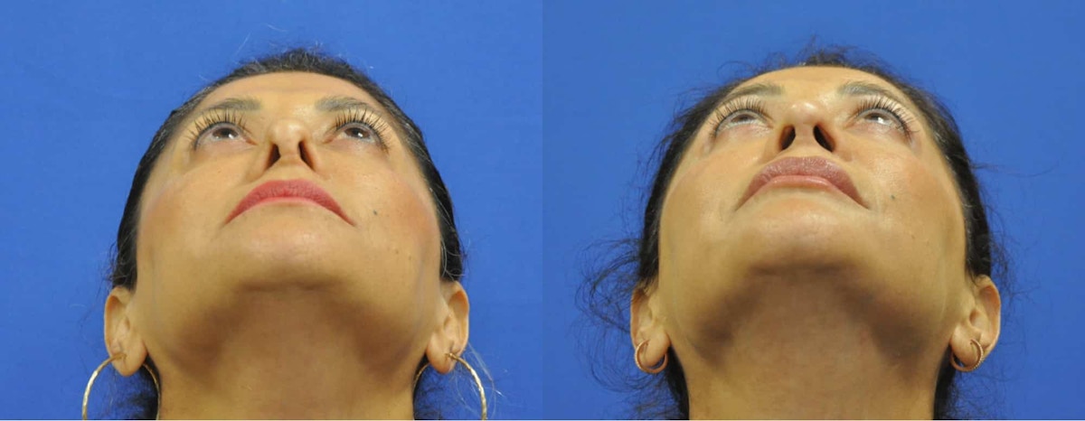Revision Rhinoplasty Before & After Gallery - Patient 427298 - Image 4