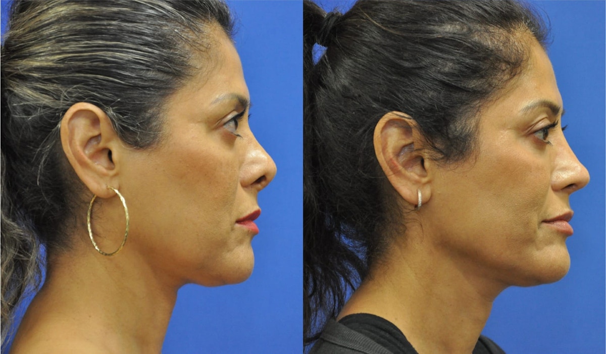 Revision Rhinoplasty Before & After Gallery - Patient 427298 - Image 5