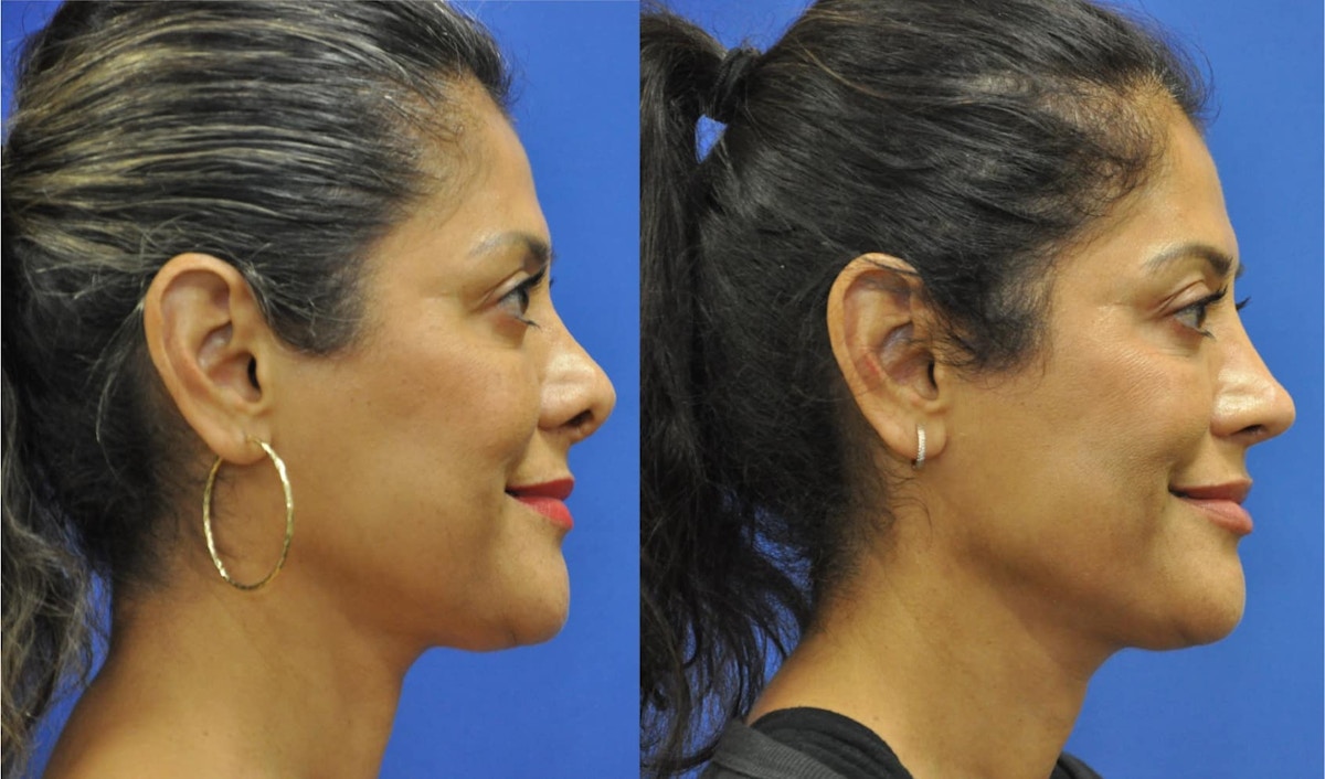 Revision Rhinoplasty Before & After Gallery - Patient 427298 - Image 6
