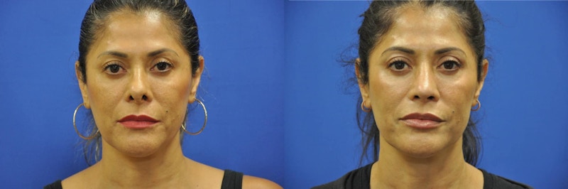 Revision Rhinoplasty Before & After Gallery - Patient 427298 - Image 1