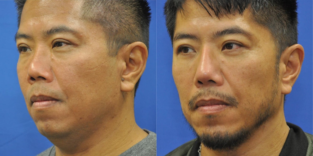 Revision Rhinoplasty Before & After Gallery - Patient 428646 - Image 2