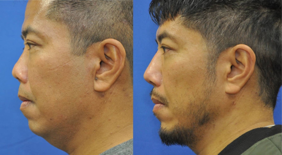 Revision Rhinoplasty Before & After Gallery - Patient 428646 - Image 3