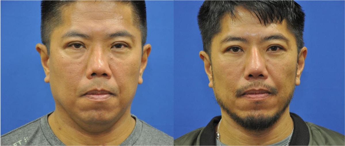 Revision Rhinoplasty Before & After Gallery - Patient 428646 - Image 1