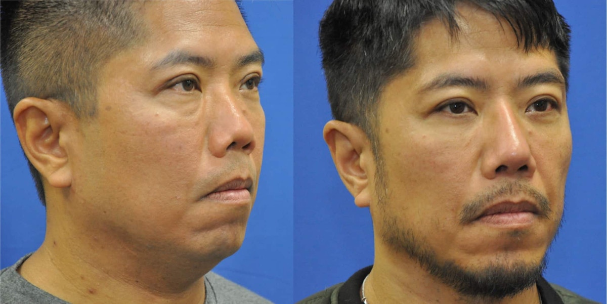 Revision Rhinoplasty Before & After Gallery - Patient 428646 - Image 4