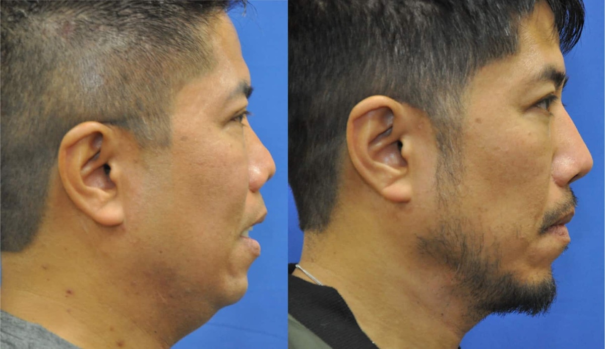 Revision Rhinoplasty Before & After Gallery - Patient 428646 - Image 5