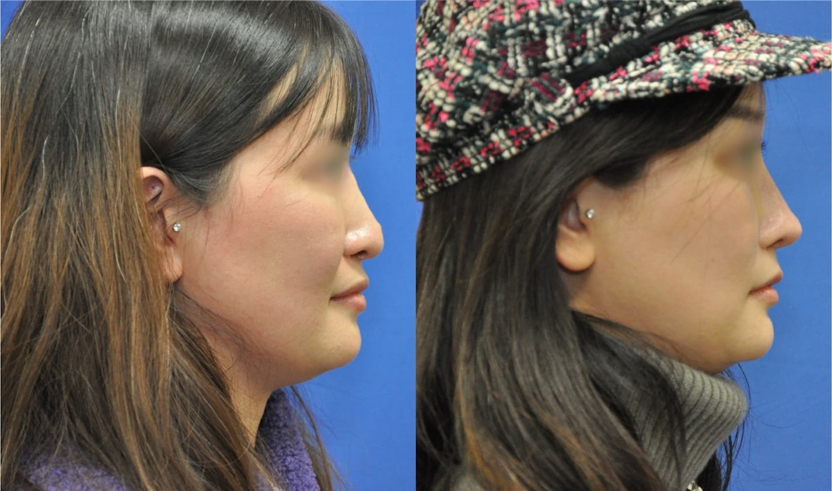 Revision Rhinoplasty Before & After Gallery - Patient 369204 - Image 2