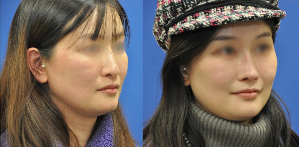 Revision Rhinoplasty Before & After Gallery - Patient 369204 - Image 3
