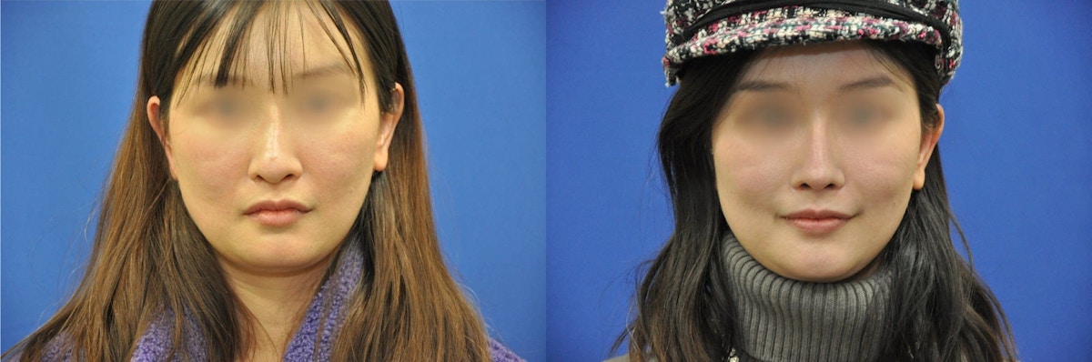 Revision Rhinoplasty Before & After Gallery - Patient 369204 - Image 1