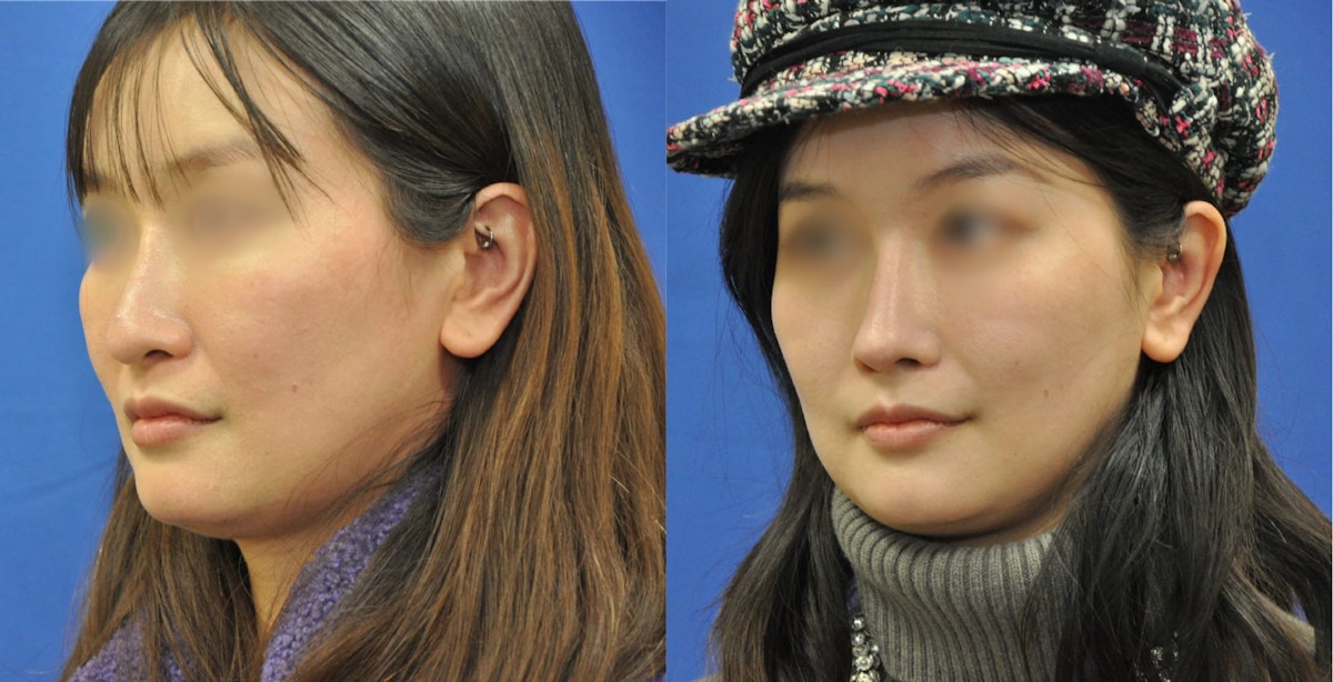 Revision Rhinoplasty Before & After Gallery - Patient 369204 - Image 4