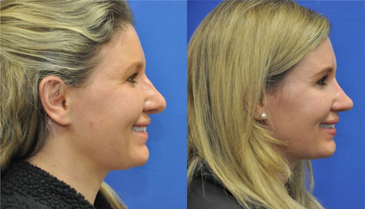 Revision Rhinoplasty Before & After Gallery - Patient 419363 - Image 2