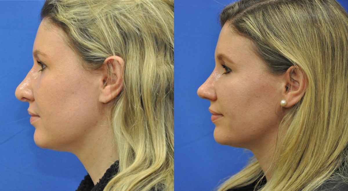 Revision Rhinoplasty Before & After Gallery - Patient 419363 - Image 3