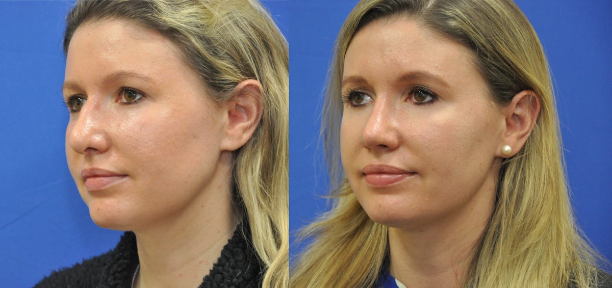 Revision Rhinoplasty Before & After Gallery - Patient 419363 - Image 4
