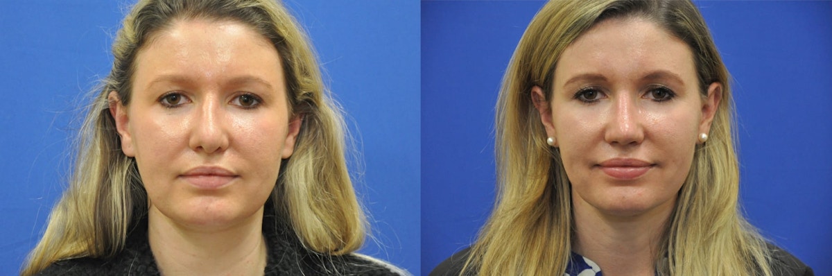 Revision Rhinoplasty Before & After Gallery - Patient 419363 - Image 1