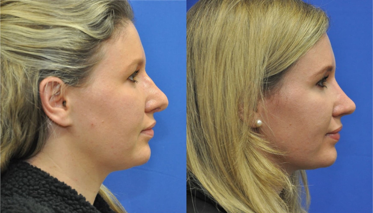 Revision Rhinoplasty Before & After Gallery - Patient 419363 - Image 5