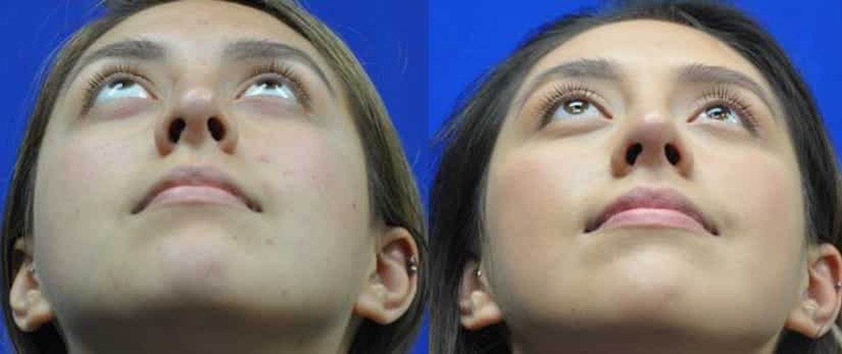 Revision Rhinoplasty Before & After Gallery - Patient 310291 - Image 5