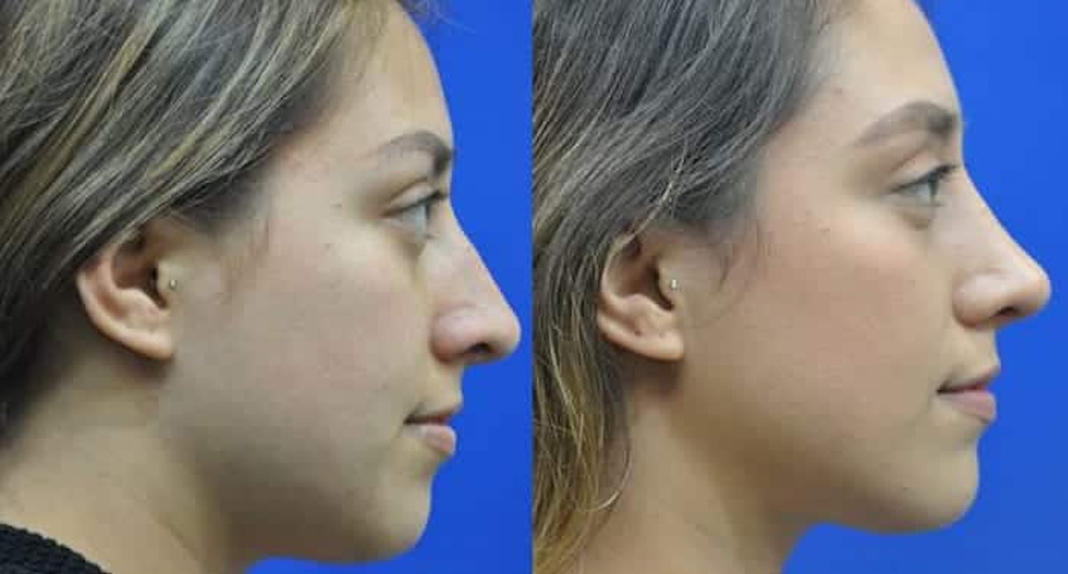Revision Rhinoplasty Before & After Gallery - Patient 310291 - Image 3