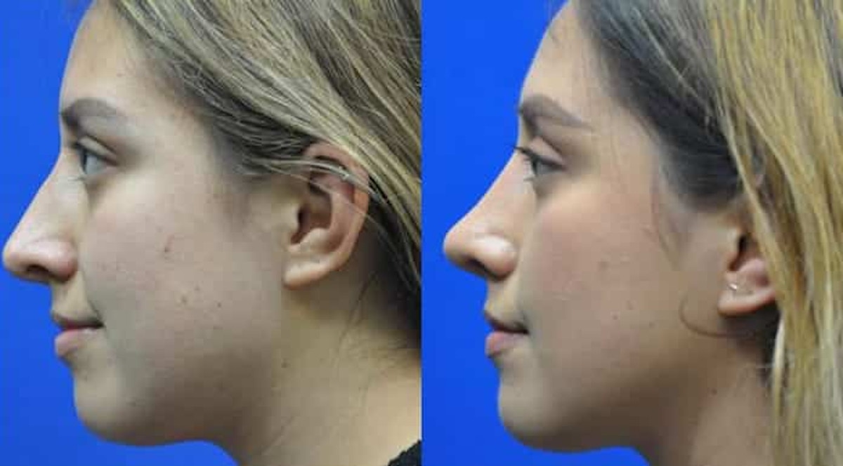 Revision Rhinoplasty Before & After Gallery - Patient 310291 - Image 4