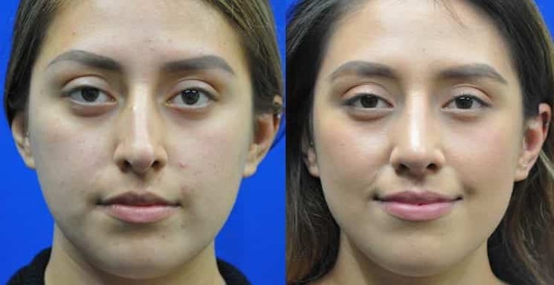 Revision Rhinoplasty Before & After Gallery - Patient 310291 - Image 1