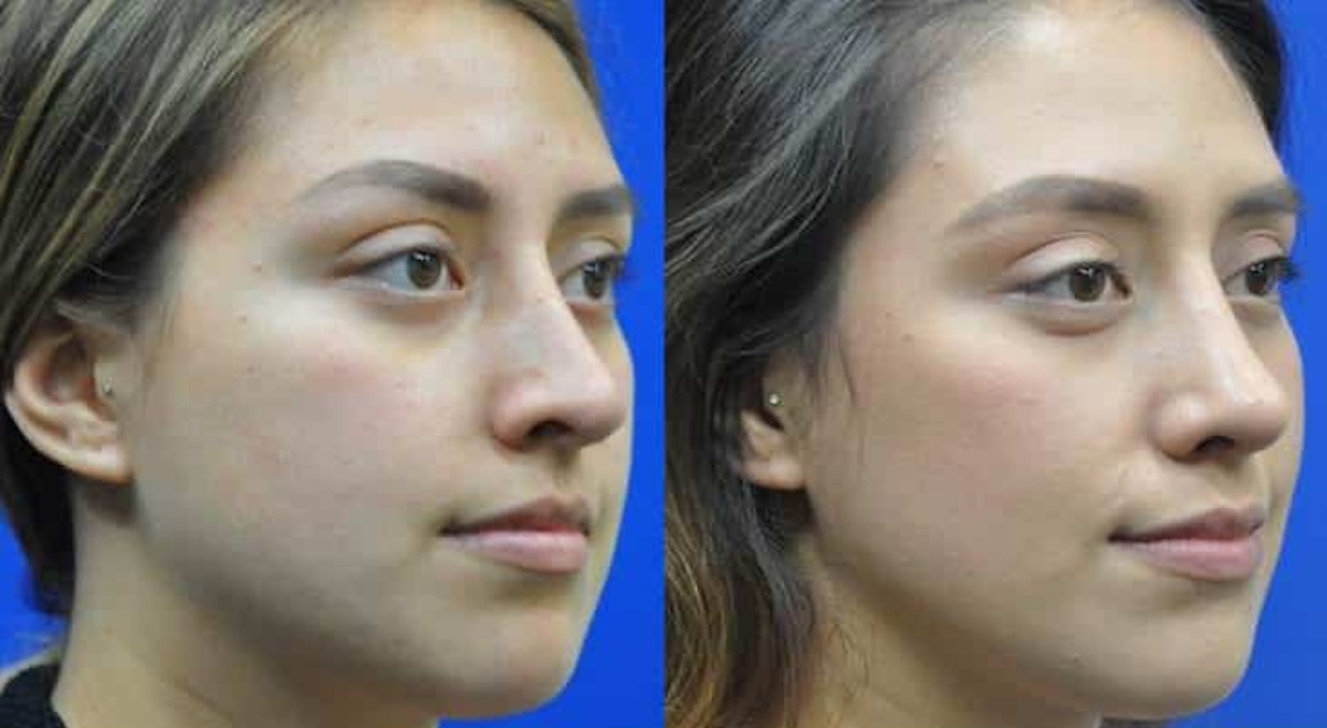 Revision Rhinoplasty Before & After Gallery - Patient 310291 - Image 6