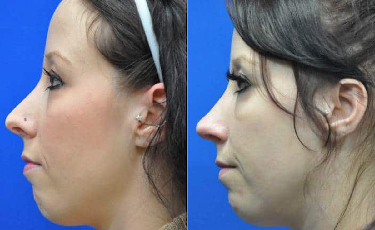 Revision Rhinoplasty Before & After Gallery - Patient 363811 - Image 2