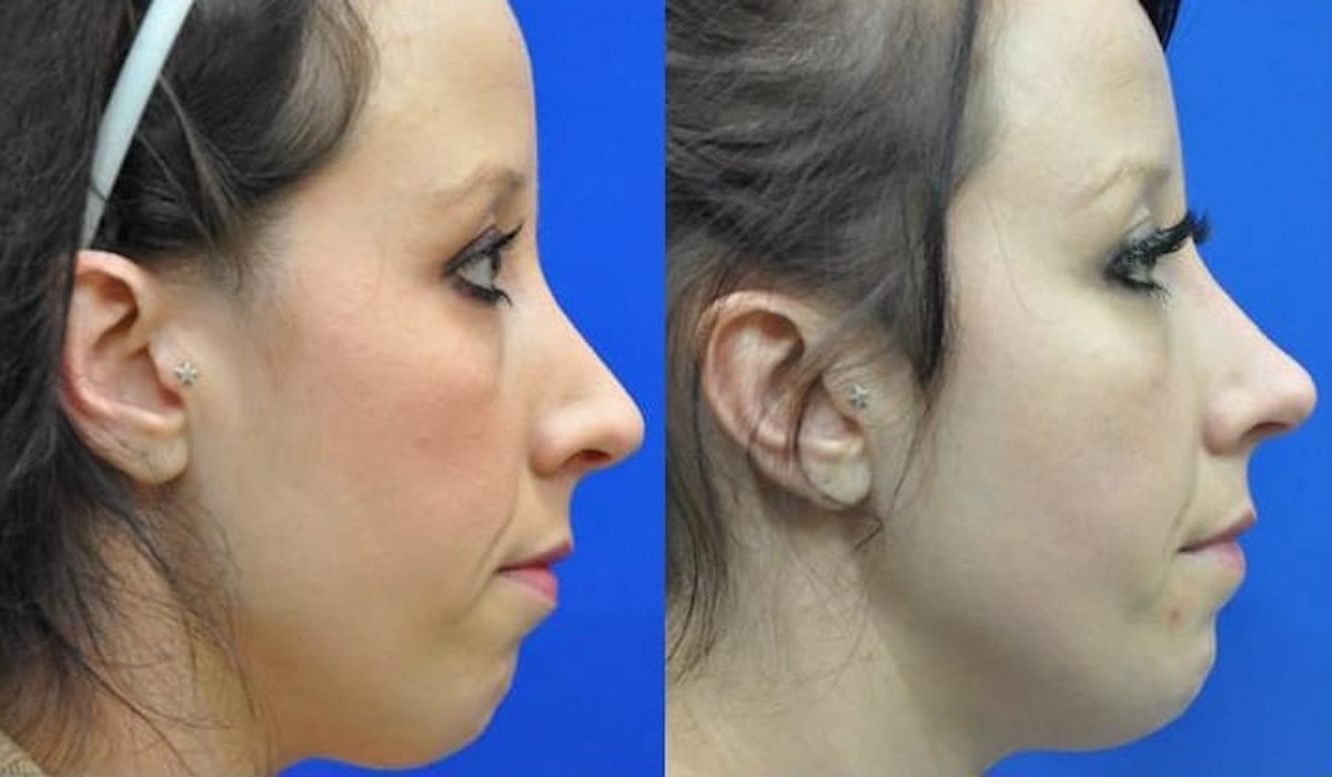 Revision Rhinoplasty Before & After Gallery - Patient 363811 - Image 3