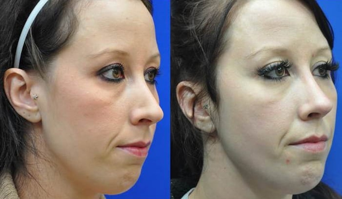 Revision Rhinoplasty Before & After Gallery - Patient 363811 - Image 4