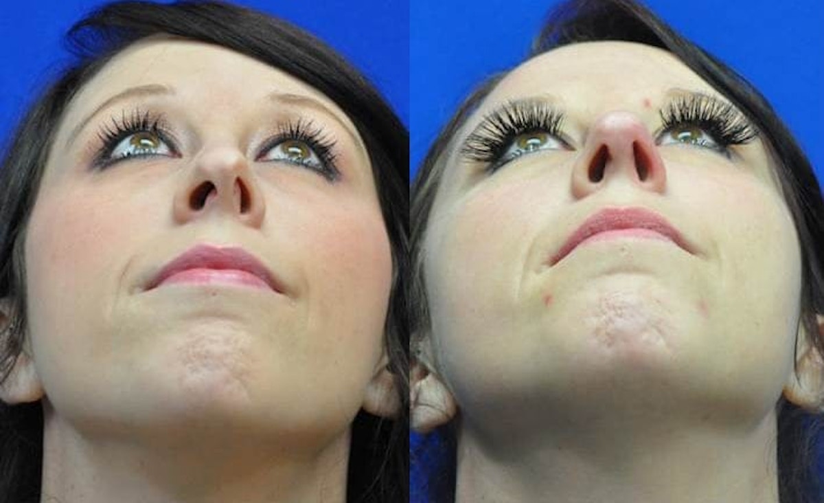 Revision Rhinoplasty Before & After Gallery - Patient 363811 - Image 5