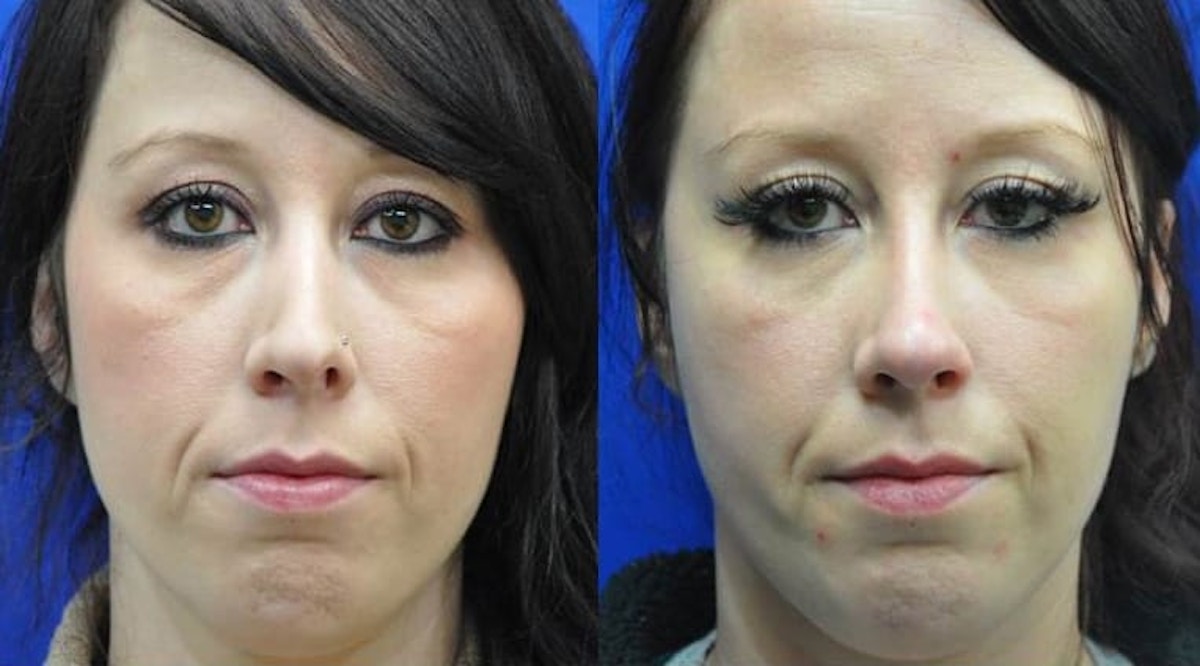 Revision Rhinoplasty Before & After Gallery - Patient 363811 - Image 1