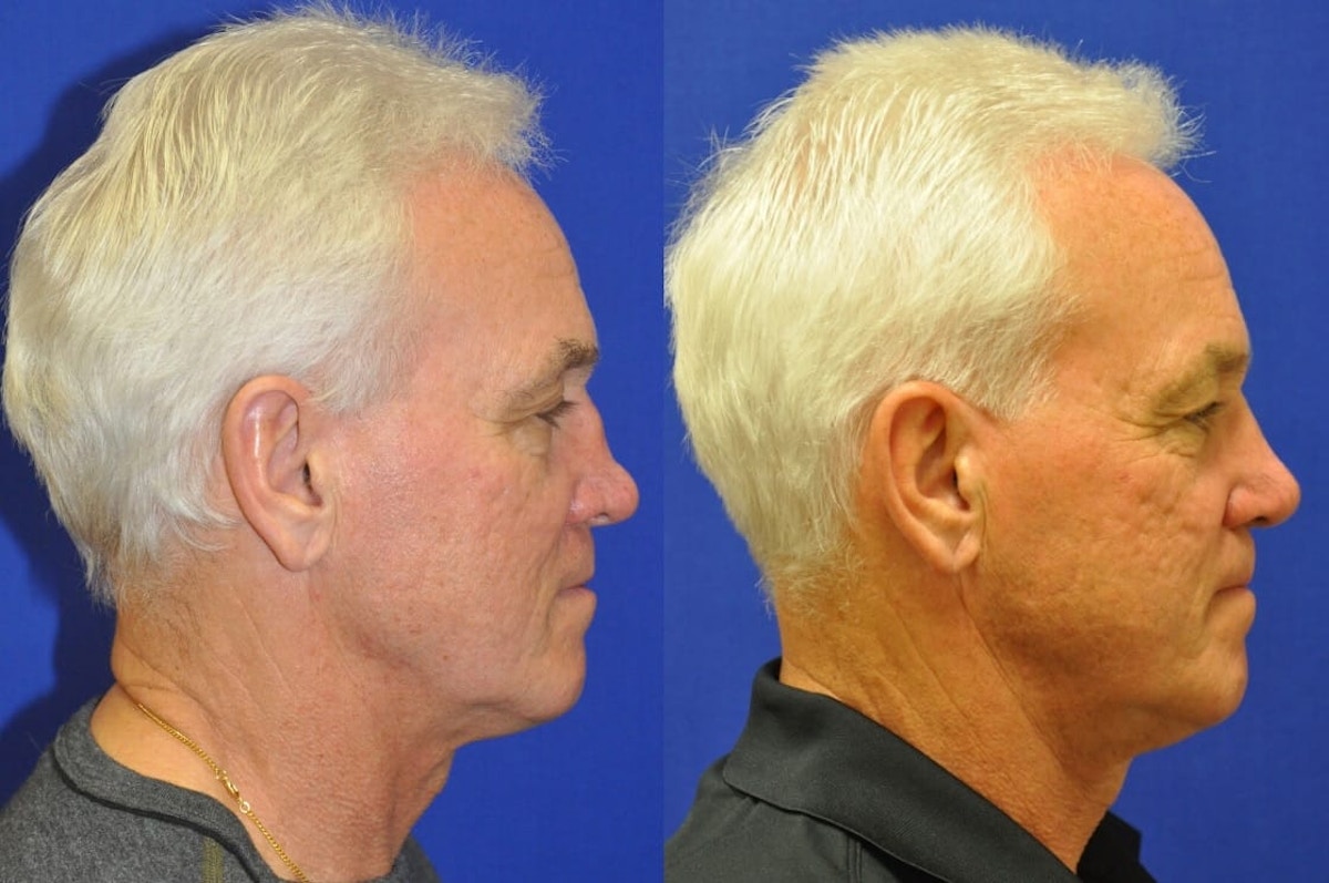 Revision Rhinoplasty Before & After Gallery - Patient 333578 - Image 2