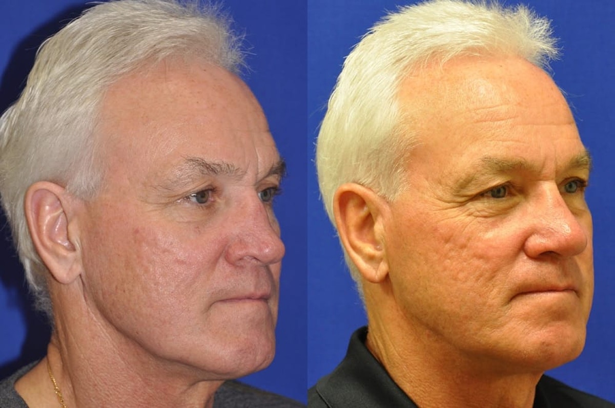 Revision Rhinoplasty Before & After Gallery - Patient 333578 - Image 3